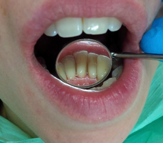 Curaprox 3960, interdentální kartáčky (TePe 0,4 a 0,5) Odstranění zubního kamene