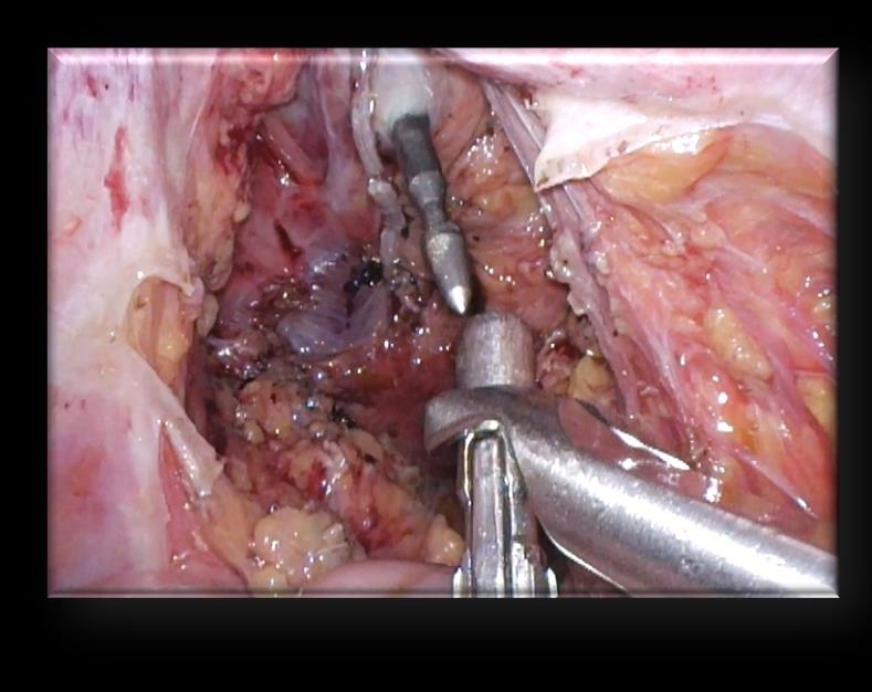 Subtotální kolektomie + IS (ilostomia) + FMR (fistula mucosa