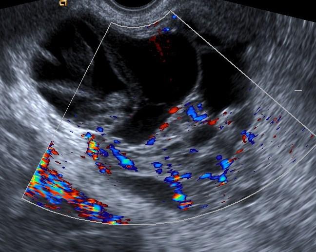 Ze zobrazovacích metod je metodou volby ultrazvukové vyšetření. Základním cílem ultrazvukového vyšetření v předoperační diagnostice je rozlišit mezi normálním a suspektním nálezem na adnexech.