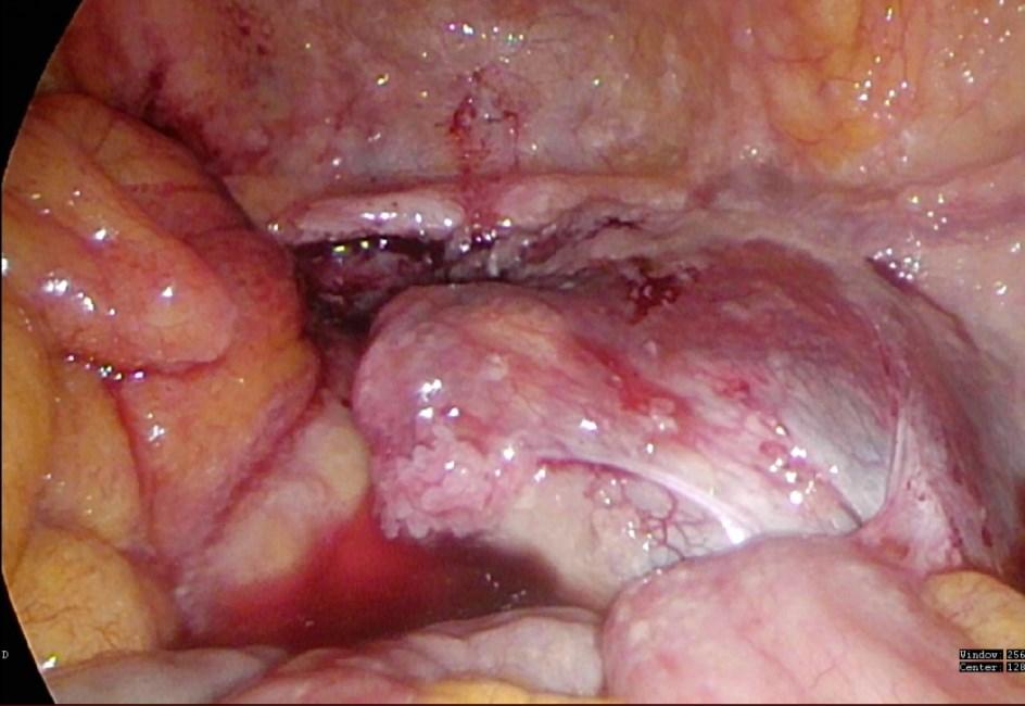 snaha o maximální cytoredukční výkon. Není li po třech cyklech neoadjuvantní chemoterapie nález operabilní, pacientka pokračuje ve třech až šesti cyklech chemoterapie.