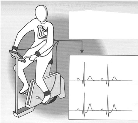 Zátěžové EKG Pozitivita zátěžového testu: EKG známky