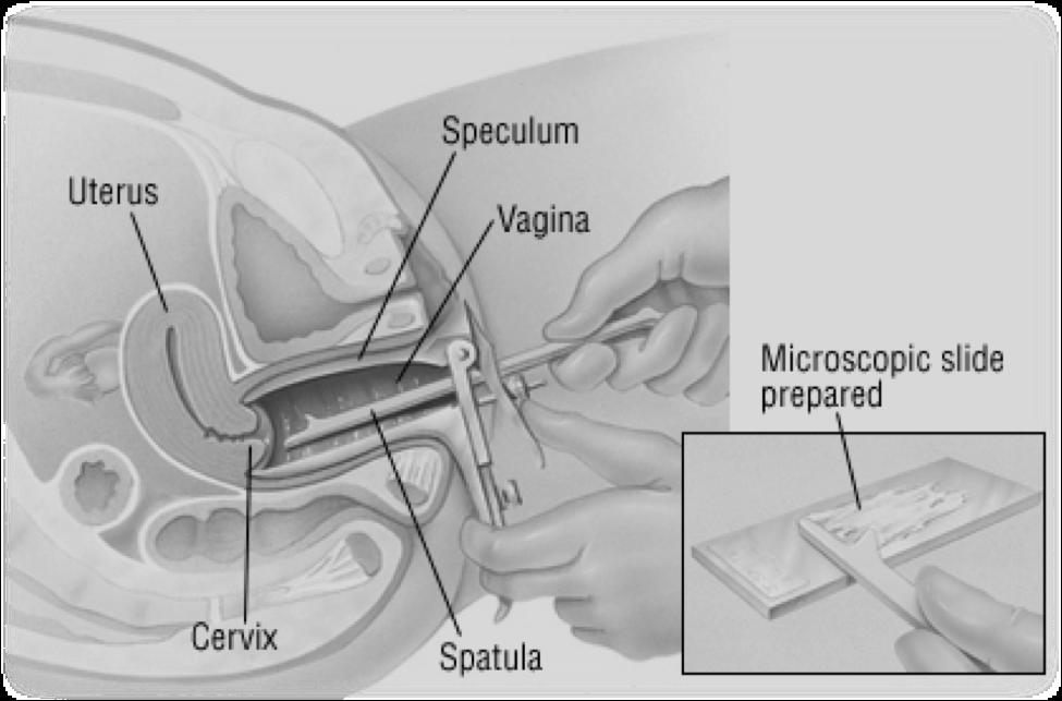 Cervikovaginální cytologie Žádný test v historii nebyl úspěšnější v boji s rakovino Ale: cervikovaginální cytologie není dokonalá!