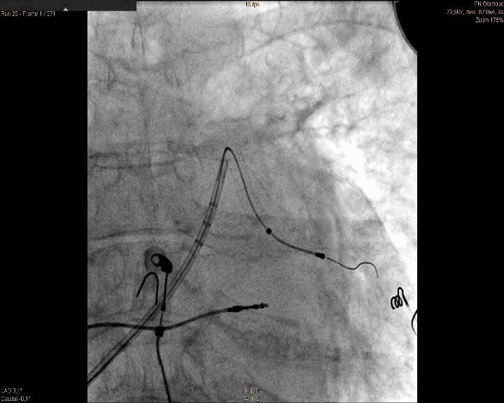 Pacientka s PCI anterolaterální