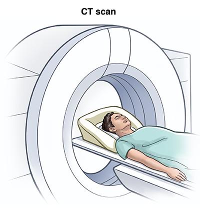 CT screening benefit vs.