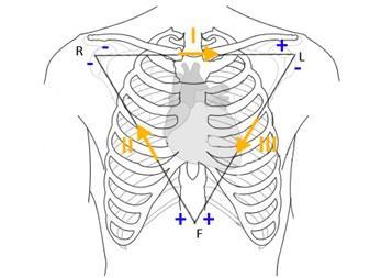 EKG základní, bipolární (Einthovenovy svody) R I L S EKG vzniká promítáním elektrického srdečního