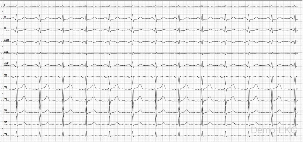 EKG 12