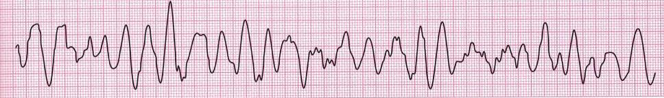 vzhled je charakteristický vysokými, bizardními komplexy QRS s frekvencí nad 100/minutu. Rytmus komorových tachykardií je nepravidelný s frekvencí komor 150-200/minutu.