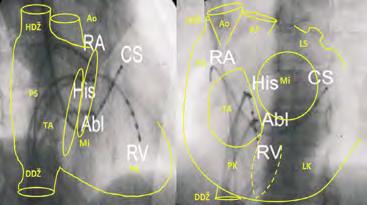 2 Základy srdeční elektrofyziologie a katétrových ablací A B Obr. 2.3 A pravá šikmá projekce (RAO right anterior oblique), B levá šikmá projekce (LAO left anterior oblique).