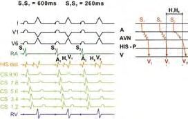 4 Základy srdeční elektrofyziologie a katétrových ablací A B Obr. 4.