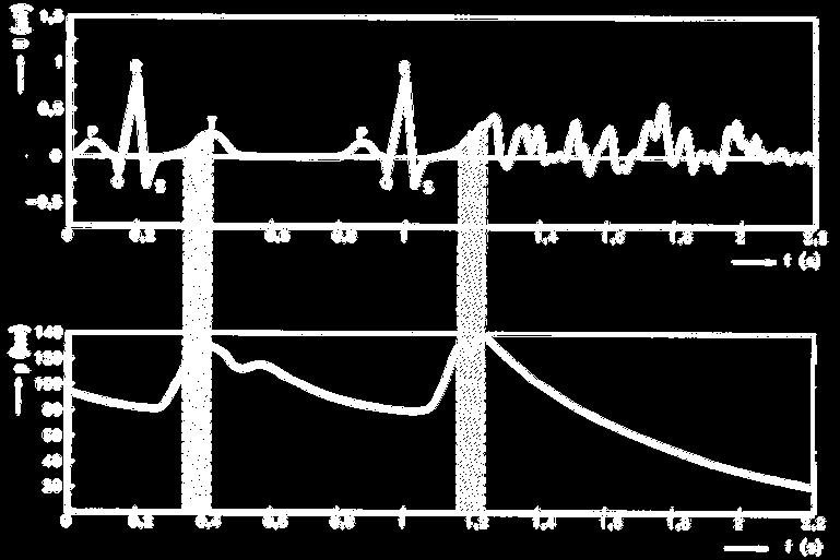 SRDEČNÍ CYKLUS EKG Normální perioda Zásah