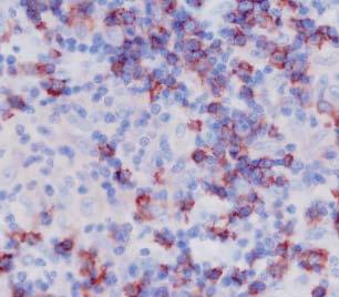 tumor-associated macrophages - negat. prognost.