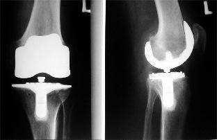 V současné moderní medicíně se při totální endoprotéze kolene nahrazují pouze poškozené kloubní plochy. Celé koleno není nahrazováno.