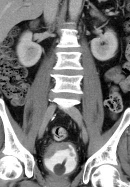 CT tumor m.