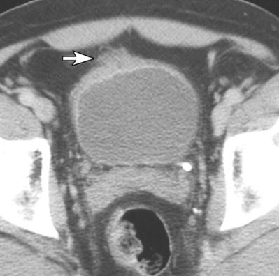 CT staging Kundra V., Silverman P. M.