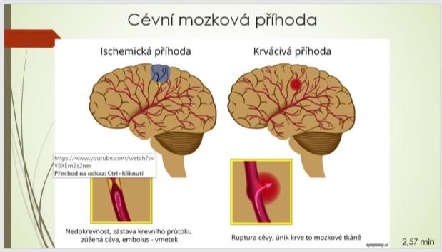 (9) Příloha 3: Ateroskleróza Ischemická choroba srdeční Infarkt myokardu Mozková mrtvice Trombóza Vysoký krevní tlak Kornatění tepen Nedostatečné prokrvení srdce v důsledku zužování srdečních tepen