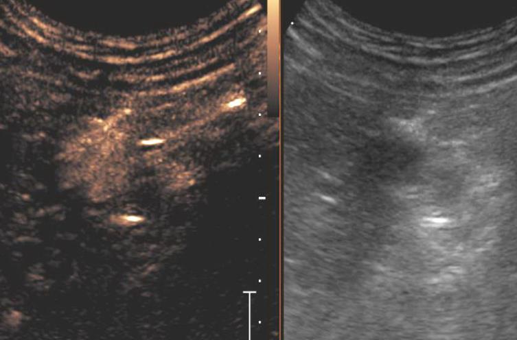 CEUS hypervaskularizovaná léze s časným