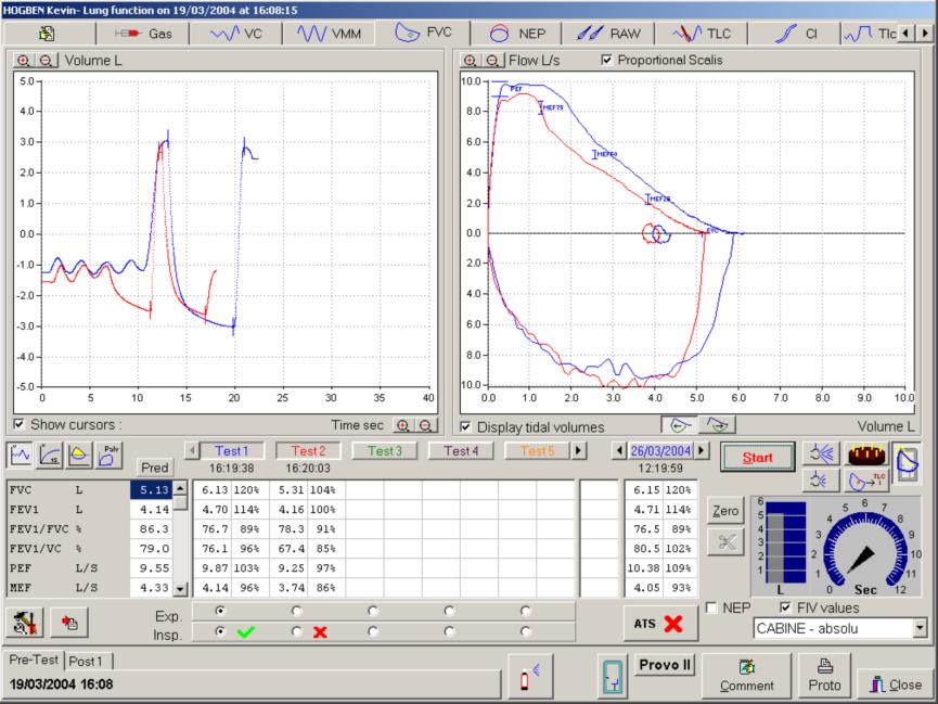 Usilovná spirometrie (křivka průtok objem) Používaná tlačítka: Spuštění testu Ověření kalibračním válcem Odstraní síťový drift přístroje Zvětšení nebo zmenšení měřítka grafu Zobrazí data ve vztahu k