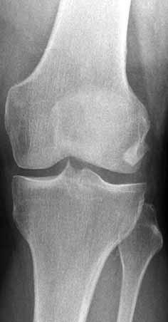 442/ Acta Chir Orthop Traumatol Cech. 84, 2017, No. 6 PŮVODNÍ PRÁCE ÚVOD Luxace pately je relativně časté poranění kolenního kloubu u mladých pacientů.