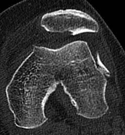 V mnoha případech dojde k pora - nění chrupavky pately nebo laterálního kondylu femuru, případně obou zmiňovaných částí kloubní plochy, přičemž právě u konzervativní léčby toto poranění velmi často