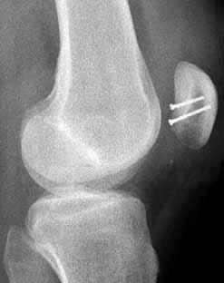 Rtg snímek kolenního kloubu po reinzerci osteochondrálního fragmentu kloubní plochy pately pomocí šroubků 6 2,0 mm (AP