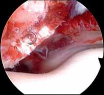 Rtg snímek kolenního kloubu po reinzerci osteochondrálního fragmentu kloubní plochy pately pomocí šroubků 2,0 mm (axiální