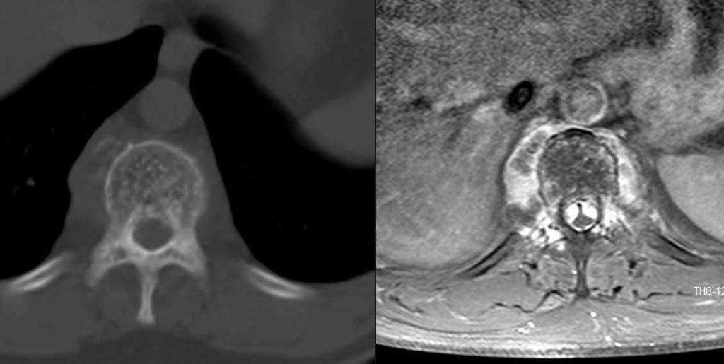 Srovnání CT a MRI CT břicha s KL p.