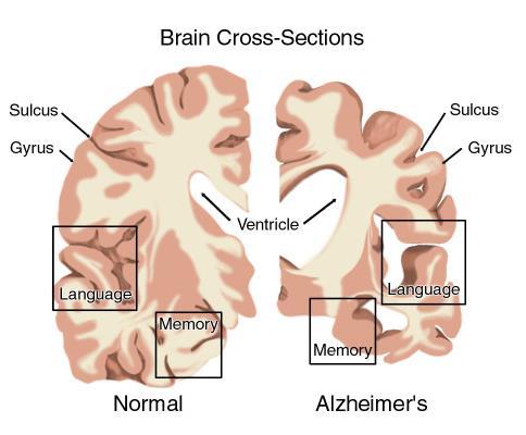 Obrázek 4 Srovnání mozku zdravého člověka s mozkem člověka postiženého AD, (Hyršová, 2012) V dnešní době není Alzheimerova choroba vyléčitelná, ale používaná léčiva, tzv.