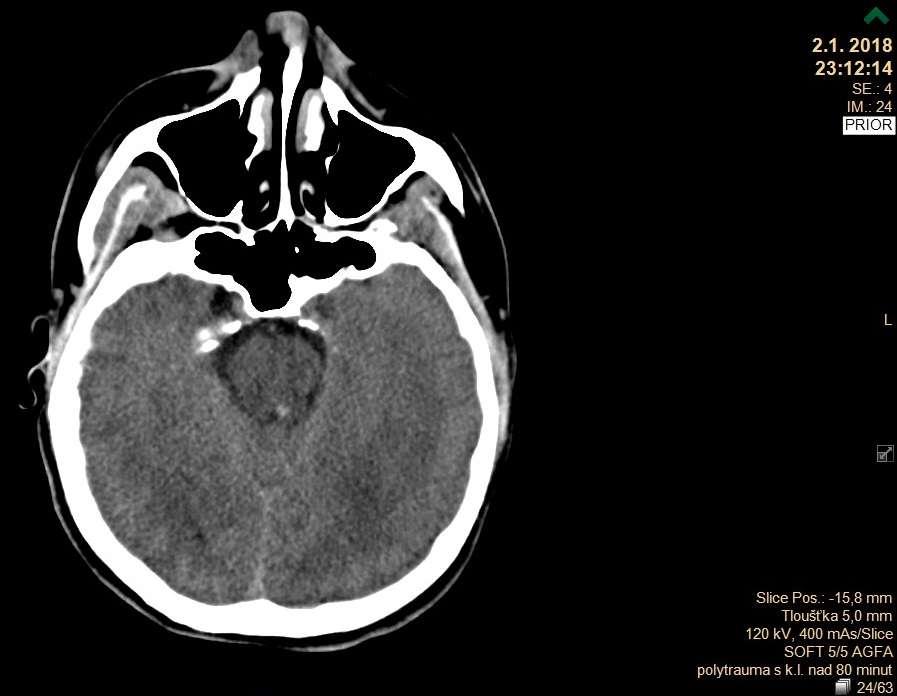 Kazuistika - 29. letý muž, polytrauma po autonehodě na místě bezvědomí,anizokorie DAP s krvácením do pontu a mezencephala, fr. foramen magnum, occp. kondylu,kontuze plic, fr.