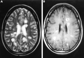 T2 MRI: řada lézí různé velikosti kortiko-subkortikálně bilat. B.