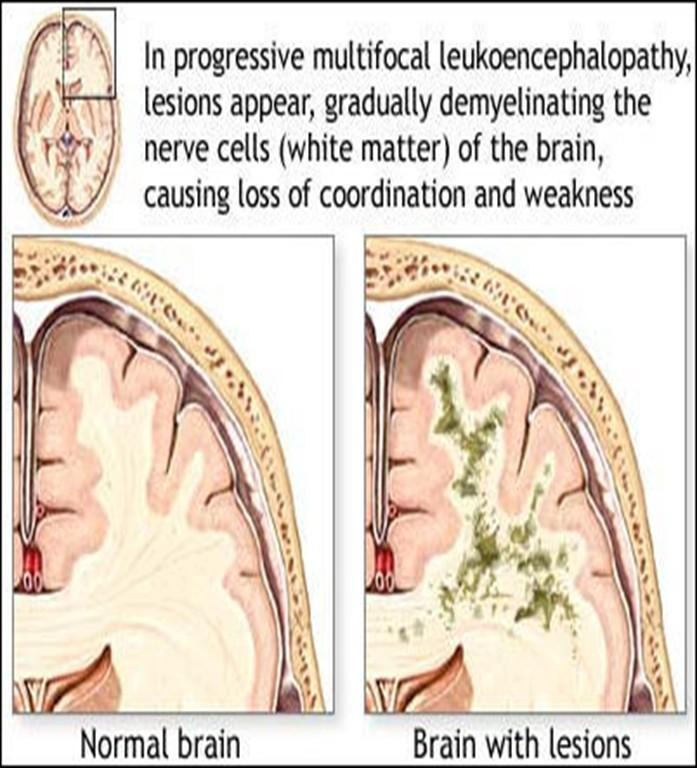 ESKALACE LÉČBY RR RS NEJÚČINNĚJŠÍ = NATALIZUMAB (Tysabri) = monoklonální protilátka proti adhezivní molekule na povrchu lymfocytů brání vstupu aktivovaného lymfocytu do CNS a tím snižuje zánětlivou