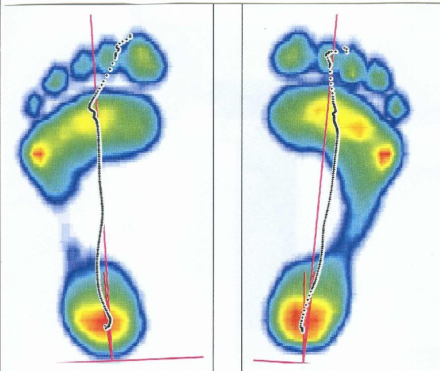 Obr. 24 scan nohy před terapií (zdroj Rsscan) Obr.