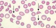 Hematologické změny u CAPS trombotická mikroangiopatie mikroangiopatická hemolytická anemie a trombocytopenie.