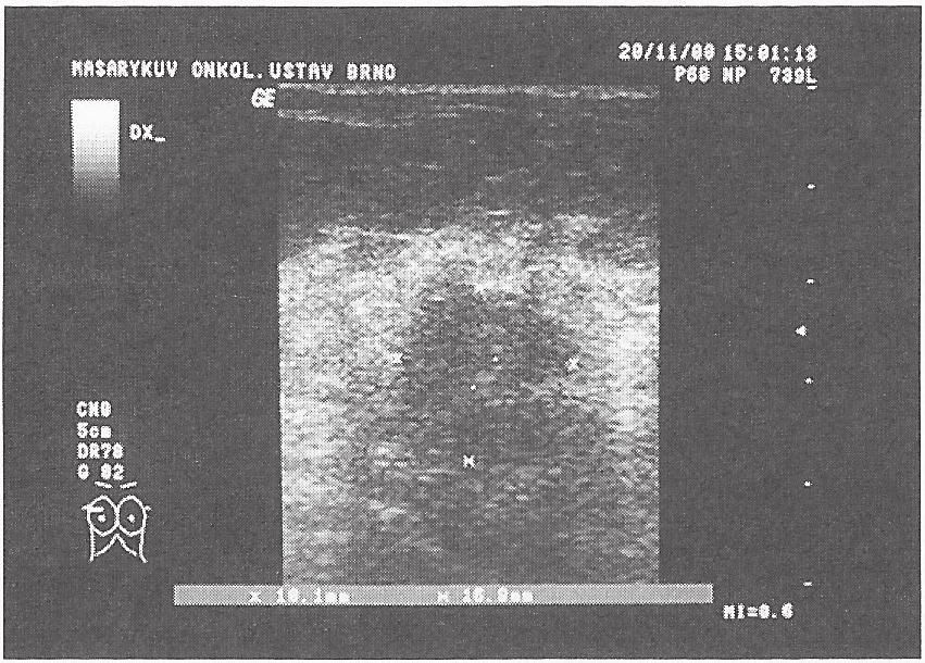 2. Ultrazvukové vyšetření Ultrazvukové vyšetření je doplňková, hojně používaná nezatěžující metoda, užitečná především k rozlišení cyst vyplněných tekutinou od jiných útvarů.