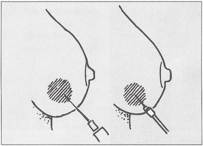 Druh biopsie volíme podle charakteru přítomné změny, tzn. je-ii hmatná při klinickém vyšetření nebo viditelná pouze na mamografu. Obrázek číslo 5. Bioptické techniky 1.