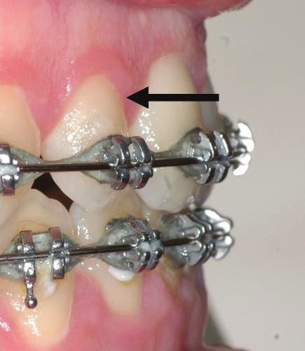 Lékař je tak nucen použít menší oblouk, aby napravil rotovaný zub, čímž dochází ke zbytečnému prodlužování léčby.