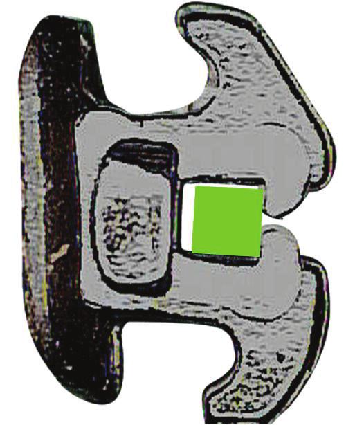 Během uzavírání mezer musí být řezáky připevněny k oblouku, aby byla torze pod kontrolou.