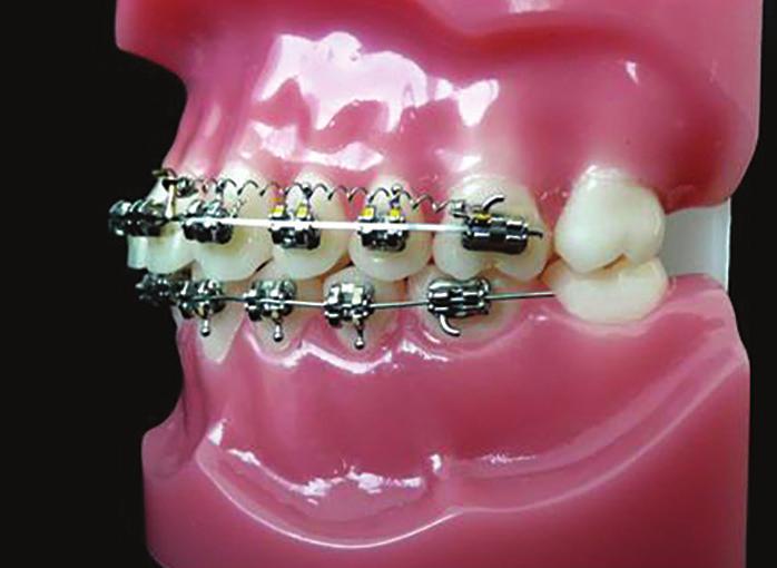 Navíc je možné napojit na zámky elastické řetízky a dodatečně je použít pro derotaci výrazně rotovaných zubů.