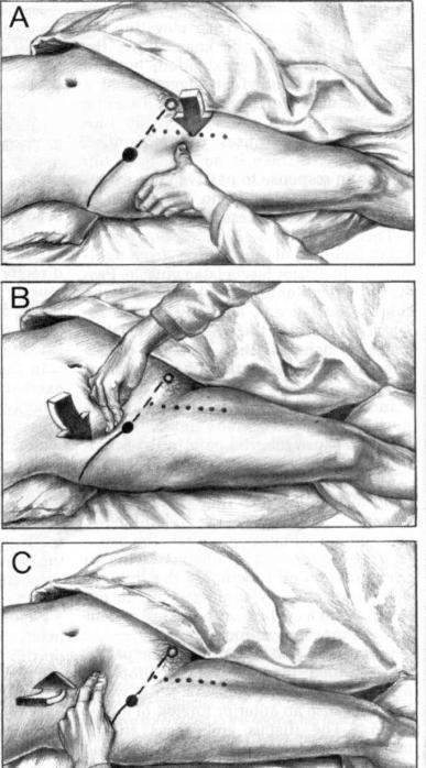 Vyšetření m. iliopsoas palpačně se provádí v leže na zádech se spuštěnou dolní končetinou vyšetřované strany (viz obr. 10). Anatomicky se tento sval rozděluje na m.psoas major et minor a na m.