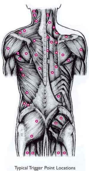 1.3 Trigger point Myofasciální trigger point (TrP) spoušťový bod, je palpačně tuhý hyperiritabilní uzlík ve svalovém snopci 2-6 mm velký.