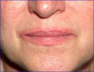 kontaktních alergenů a rozvoji reakce pozdní přecitlivělosti (2). Dutina ústní se také odlišuje přítomností slin, které ředí a odplavují chemické látky, a rychlou regenerací (3).