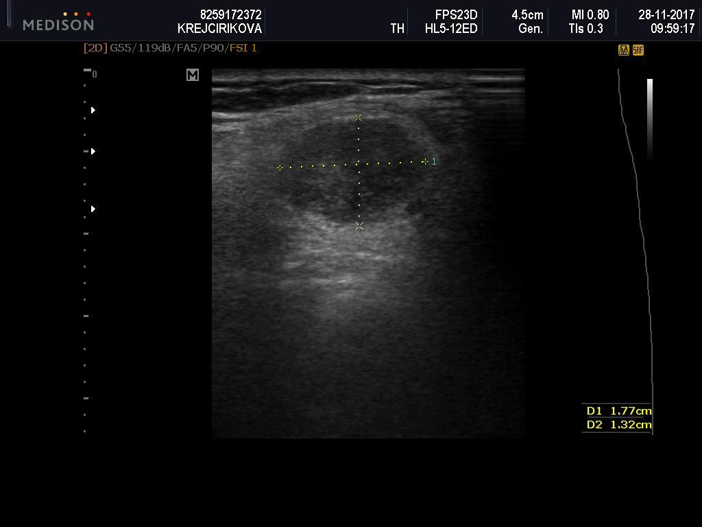 Při sonografii štítné žlázy a krku se setkáváme s: metastázami v uzlinách výskytem lymfomu, nádory příštítných tělísek, perzistujícím thymem, ektopickou štítnou žlázou,