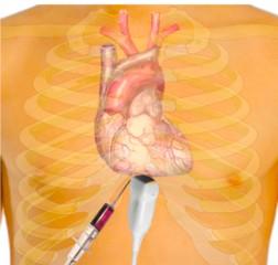 tamponáda Hypotermie