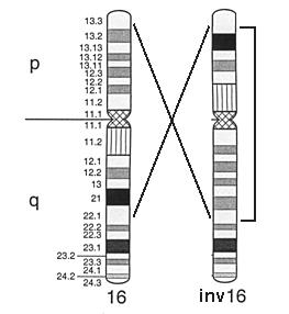 Onkogenetika Strukturní CHA : Inverze AML-M4eo inv(16), t(16;16) fúzní gen CBF/MYH11 asi 50%