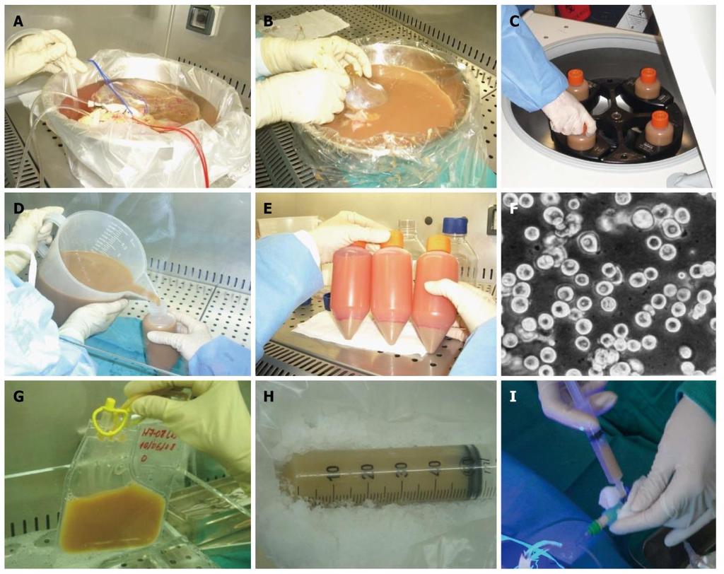 Hepatocyte transplantation Ibars JP.