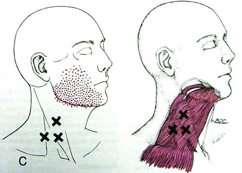 m. platysma Aktivace TrP: sekundárně z TrPs v m.scm TrP a ZRB: překrývají m.