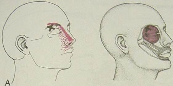 m. orbicularis oculi Palpace svalu: kolem otevřeného oka kolmo na vlákna směrem k hornímu okraji orbity jemně konečky prstů TrP a ZRB: Trp se nejčastěji nachází superiorně