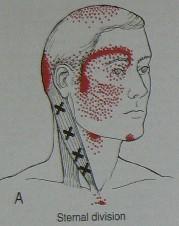 m. sternocleidomastoideus TrP a ZRB: sternální část TrP horní bolest occiputu, vertex TrP střední bolest na homolater.