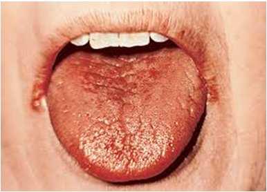 Dehydratácia Príznaky a dôsledky v ústnej dutine Xerostómia Znížená tvorba slín Suchá koža a sliznice Opuchnuté a bolestivé slinné žľazy Zápalové zmeny cheilitída, glositída riziko kazu riziko