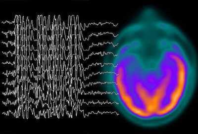 Nejčastější komorbidity DA Mentální retardace 75% DA 30% mírná a středně těžká MR 45% těžká a hluboká MR Epilepsie 25% DA (x běžná populace 0,5%) Jiná