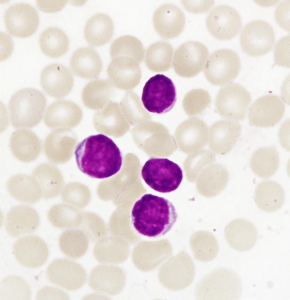 blastická transformace CLL Stano-Kozubik K. et al.